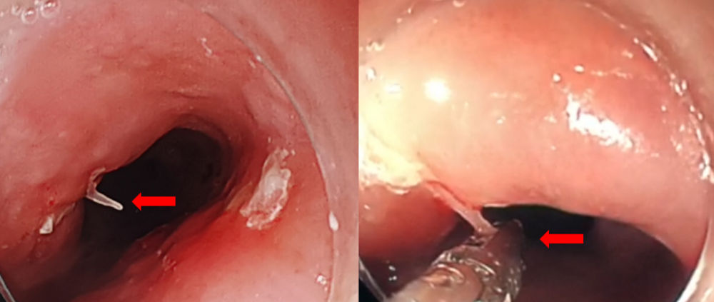 食管|女子硬吞饭团把鱼刺扎进主动脉医生：鱼刺卡喉后“土法”不可取
