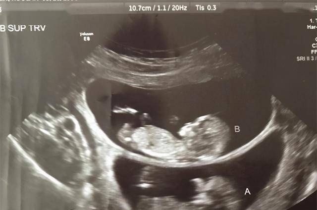 偏差|孕妇做B超时,医生总是说胎儿比实际天数多几天是为什么?