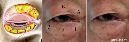 肿泡眼福音,到底怎么割,才不会出现肉条感