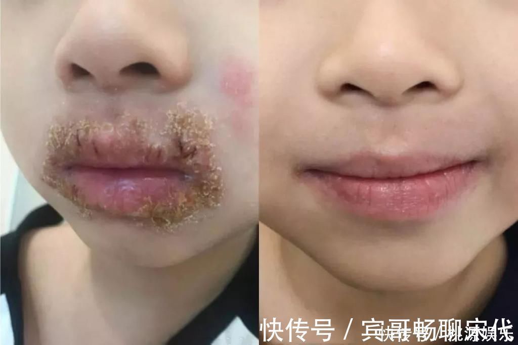 唇炎|因为1个习惯动作,5岁男童被抽血4次,这个安全隐患宝妈快自查