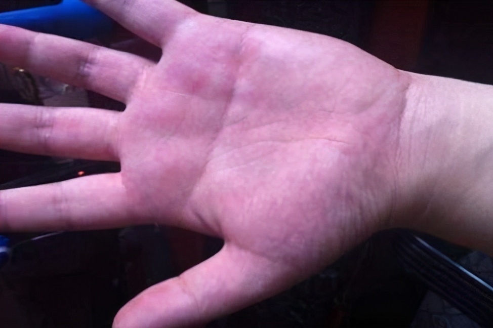 堵塞|血管堵不堵,看看手就知道,手上若有3种异常,或血管易堵塞