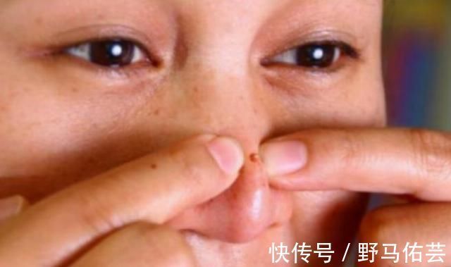 油脂|鼻子上总是挤出“白色条状物”学会这3招,和“草莓鼻”说拜拜