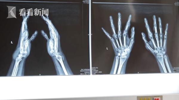 痛风患者|常吃麻辣烫喝甜饮 19岁小伙全身遍布15处“痛风石”