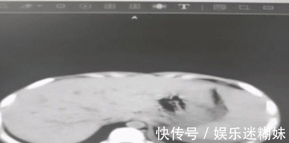 吴文波|江西一4岁男童遭遇车祸,医生又意外在他肚子里发现肿瘤