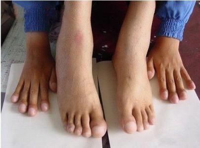 罹病率|脚趾有3种变化,说明身体有问题了,若没有,说明你还算健康!