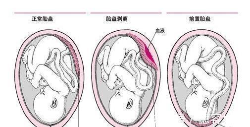 胎盘|如果孕期发现这5种异常出血情况，立刻去医院！