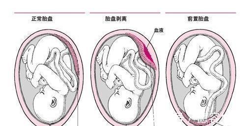 胎盘|如果孕期发现这5种异常出血情况,立刻去医院!