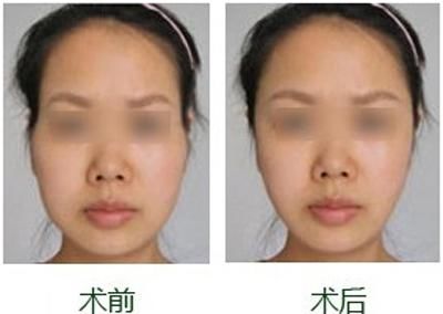 面部凹陷太显老，想要变回少女脸，你得这样做！