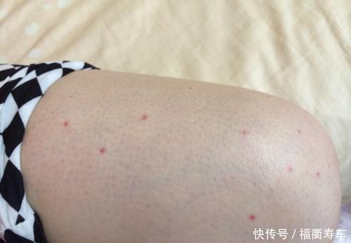 身上长了许多 小红点 可能是身体发出的 求救信号 快资讯