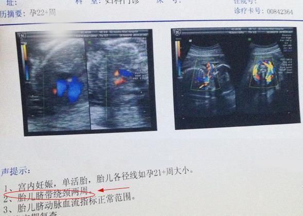 小琳|“脐带绕颈”只是因为胎儿调皮?还有这5件事,也会导致这种结果