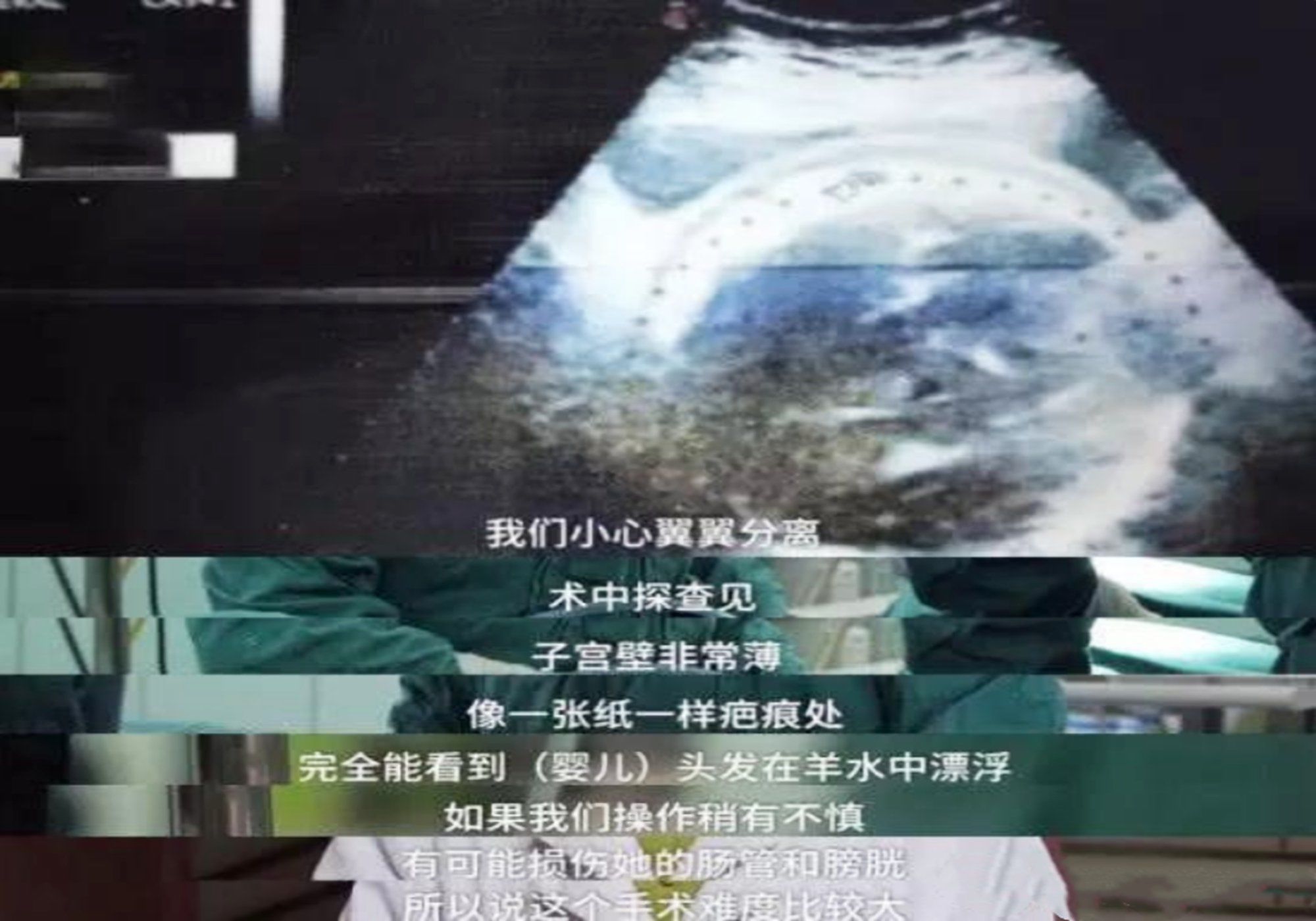 孕妇|33岁生4胎,10年剖4胎,赌命生娃值吗?别再误解剖腹产了