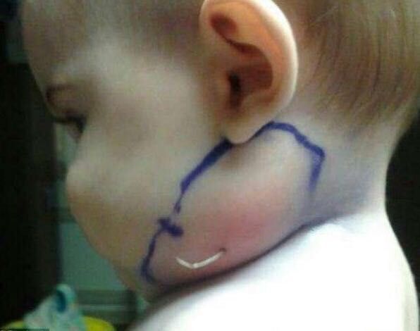 小琴|2岁宝宝哭喊挠脖子,去医院取出东西后,一家人情绪失控