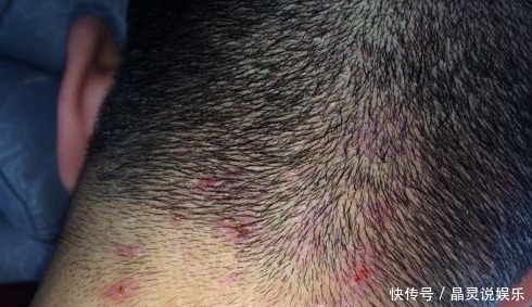 油脂|头皮上长出“小疙瘩”,可能是有大问题,为了家里人健康了解下!