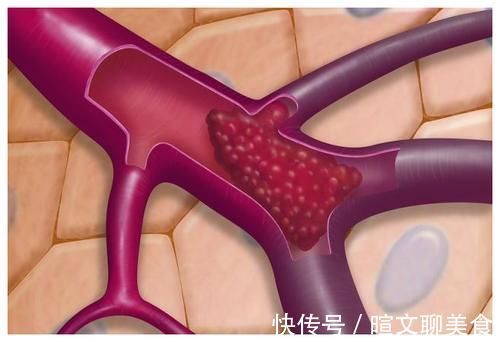 血液|“天然化栓王”发现了，每天多吃点，清血管，溶血栓，稳定血压
