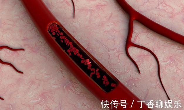 预防|这5点是冠心病最严重并发症,希望1个不要有!最全预防都在这里