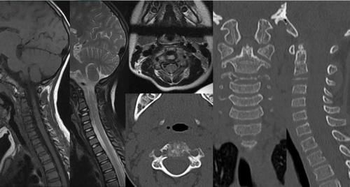 椎体|脊柱常见肿瘤及肿瘤样病变的几种影像学表现，你都见过吗？