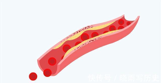 小事|血管被堵住，会给身体带来3大危害，保护血管要从这4件小事做起