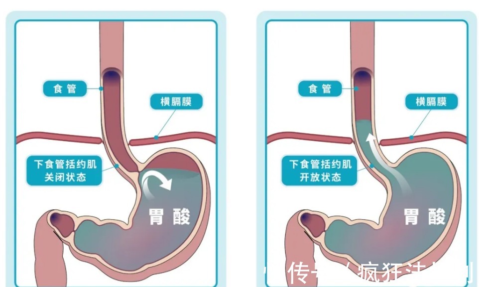 患者|治疗胃食管反流病,应该选中医还是西医?
