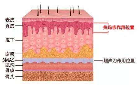 真皮层 热玛吉做完之后皮肤会不会加速衰老?不同年龄段做了热玛吉都会有什么改变?