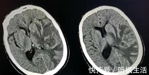 肺癌|肺癌最早爱往哪些部位转移？转移了还有救吗？