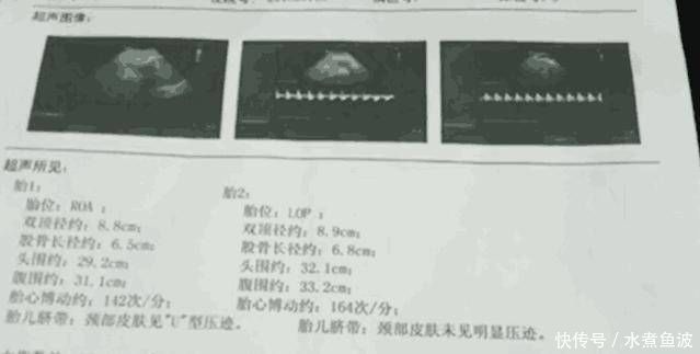 接生|孕检怀了双胞胎，医生却只接生了一个，还有一个去哪了