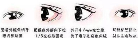 上睑提肌 做了开下眼角手术后3个月眼睛还是明显下垂还能恢复吗?