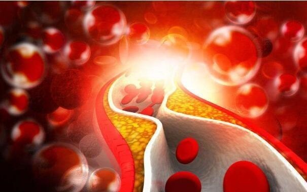 血脂高,如何让血脂降下来?医生为你总结4招,不妨试一试