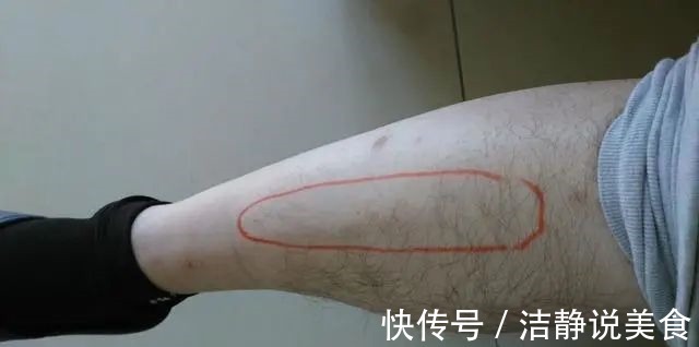 血脂|血脂高不高,看小腿就懂若有这4种症状,或在暗示血脂偏高了