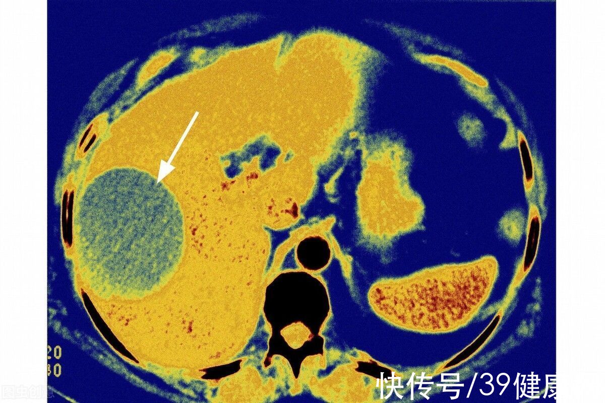 癌变|体检查出囊肿、结节、息肉是癌症先兆？要不要切？很多人都搞错了