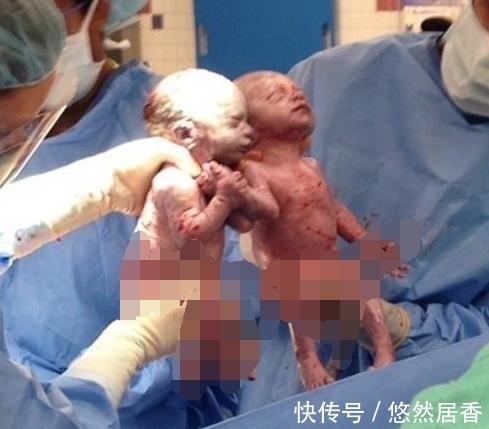 双胞胎|孕妇摔倒导致双胞胎死在腹中,孕妇抱着不松手,之后奇迹发生了