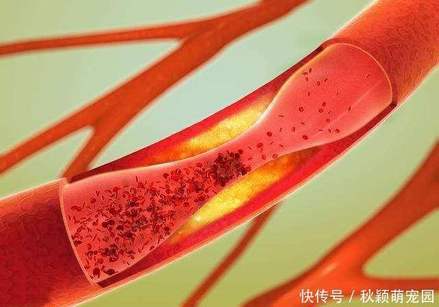 斑块|怎样才能把血管壁上的垃圾或斑块清除掉？医生告诉您答案！