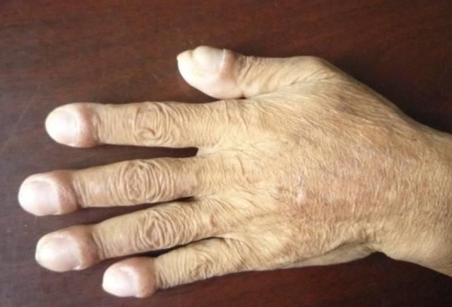 肺癌不痛不痒,可身体出现一个标志提示中晚期,最好去查下肺CT