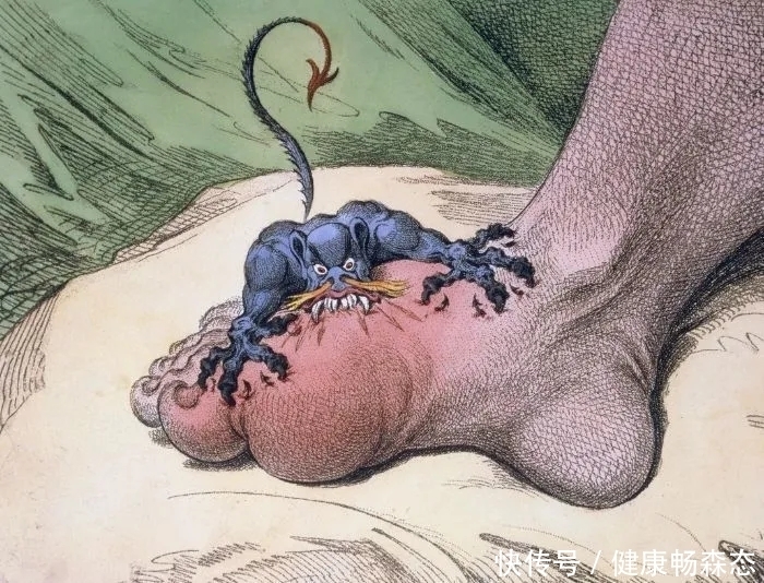 当心痛风石“啃掉”骨头!不石先生告诉你4种溶