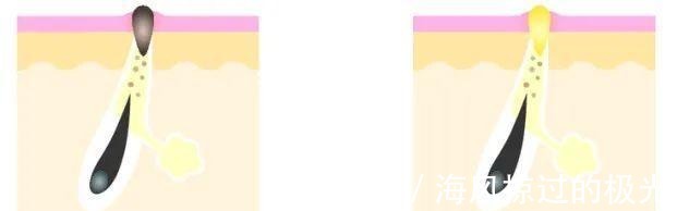 泡沫|看到黑头就想挤担心越挤越多!网上3种方法才损伤皮肤,要避开