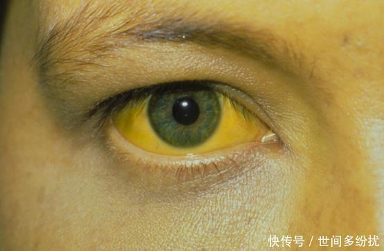  放屁|放屁过多是肝脏“示警”还是排毒世卫公布真相，现在知道还不晚