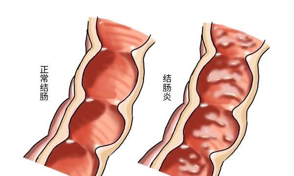 医生|“放屁多”是身体的癌症信号?多数人不清楚,听听医生怎么说