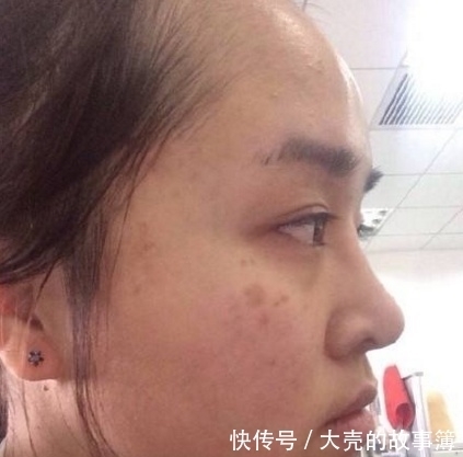 当药店不起眼的开塞露遇上它,大妈睡前来擦一下,醒来斑点消失