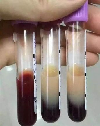 ICU|女子进补一顿吃3斤牛肉住进ICU ,抽出“奶茶血”惊呆医生!