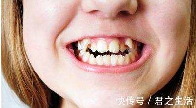 矫治|儿童做牙齿矫正三个最佳时间:家长要牢记,矫治越早干预效果越好