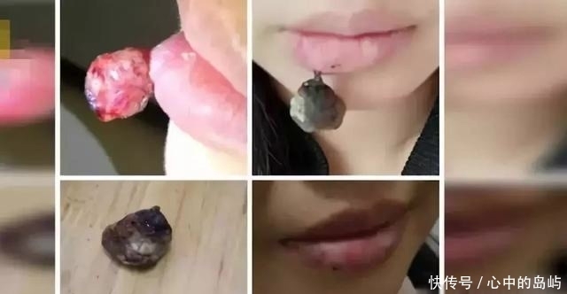 东西|嘴唇干燥不舒服,孕妇挠破了皮,没想到一个月后居然长出个可怕东西