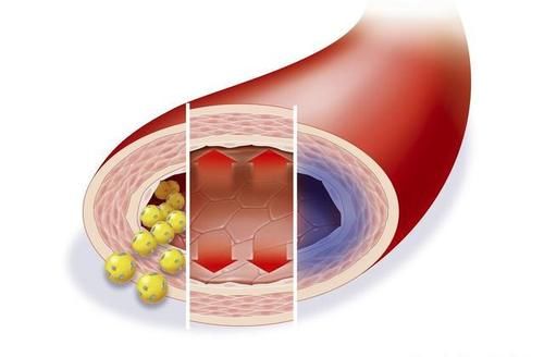 颈动脉内膜|“血管老化”的五大常见征象，您有吗？及时干预，哪些药物可选？