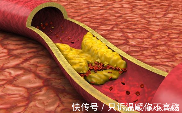 高血脂|高血压有“3怕”，最好一个不沾，牢记“2个字”，或能控血压