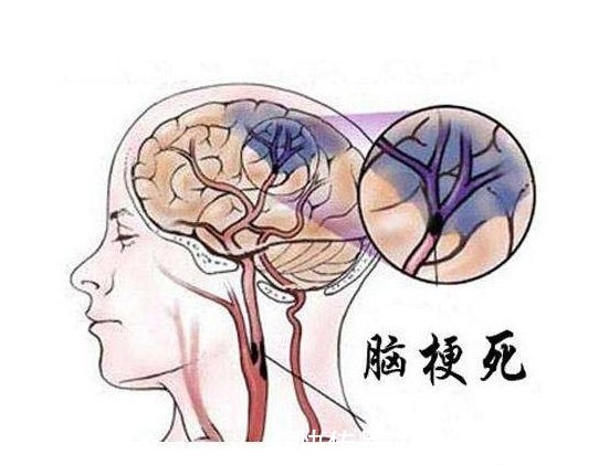 <b>急性脑梗死患者的最佳治疗方法<