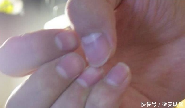 搞错|指甲上的“月牙”越多越健康吗多数人搞错了,不妨看看