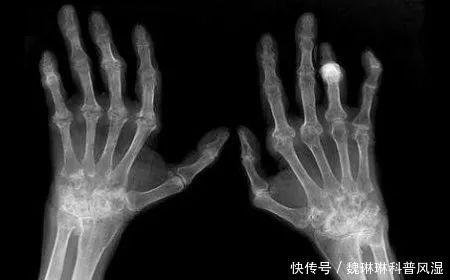 雪后天寒,类风湿患者为什么这么怕冷?又该如
