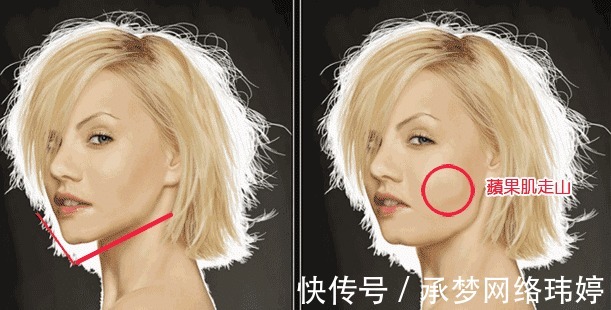 蛋白线|看完这个,你还敢做线雕隆鼻吗?