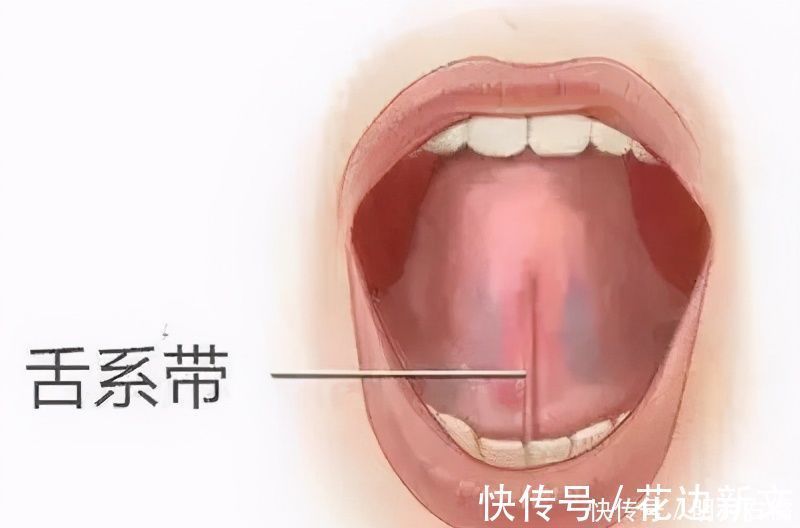 剪舌|滥用的“剪舌系带”,舌系带到底该不该剪?这一刀孩子挨得很无辜
