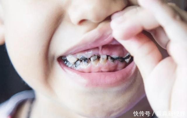 小宝宝|牙科医生提醒，孩子正在换牙的父母们，你们一直都做错了什么