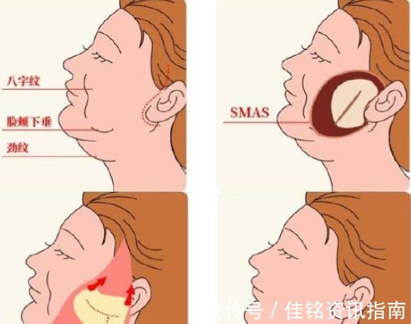 医生 维持时间短、价格贵、留疤，拉皮手术最常被问的问题，医生有话说！