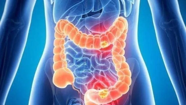 癌前病變|痔瘡還是腸癌，傻傻分不清楚？聽聽松江專家怎么說